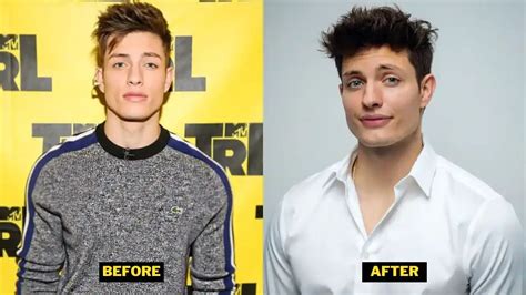 matt rife before and after plastic surgery|Matt Rife responds to plastic surgeon’s thinly veiled。